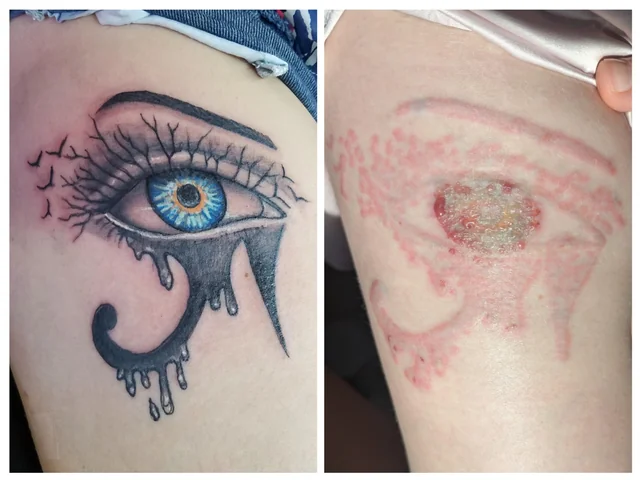 The Biggest Mistakes People Make During Tattoo Removal