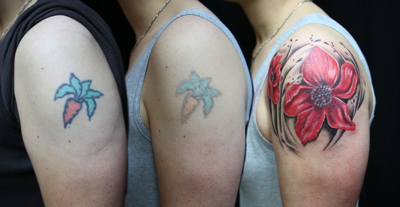 The Biggest Mistakes People Make During Tattoo Removal