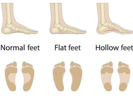 flat feet