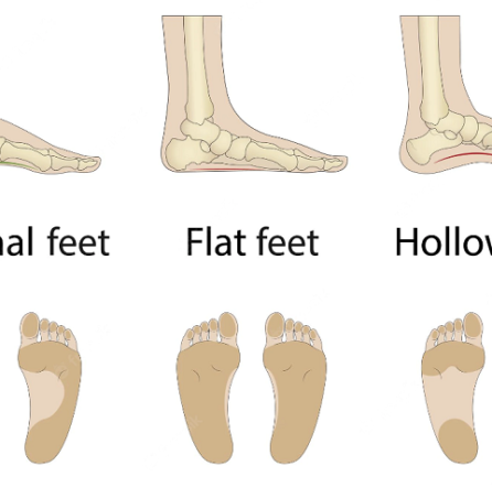 flat feet