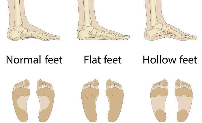 flat feet