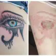 The Biggest Mistakes People Make During Tattoo Removal