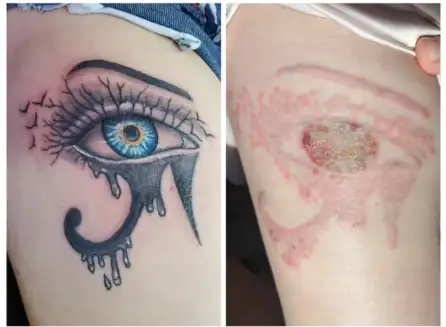 The Biggest Mistakes People Make During Tattoo Removal
