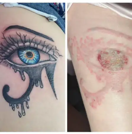 The Biggest Mistakes People Make During Tattoo Removal
