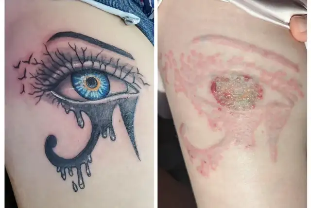 The Biggest Mistakes People Make During Tattoo Removal
